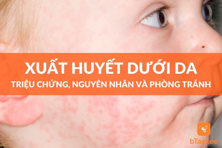 Xuất Huyết Dưới Da - Triệu Chứng, Nguyên Nhân Và Điều Trị
