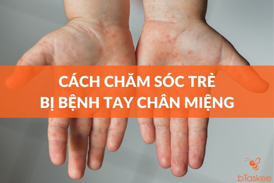 Cách Chăm Sóc Trẻ Em Bị Tay Chân Miệng Đúng Cách
