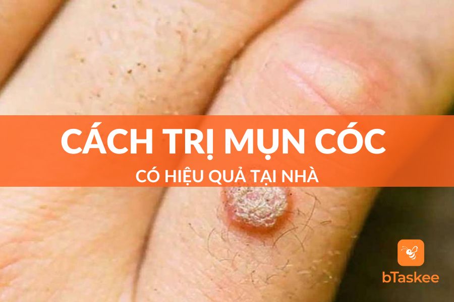 6 Cách Trị Mụn Cóc Tại Nhà Hiệu Quả Và Nhanh Nhất