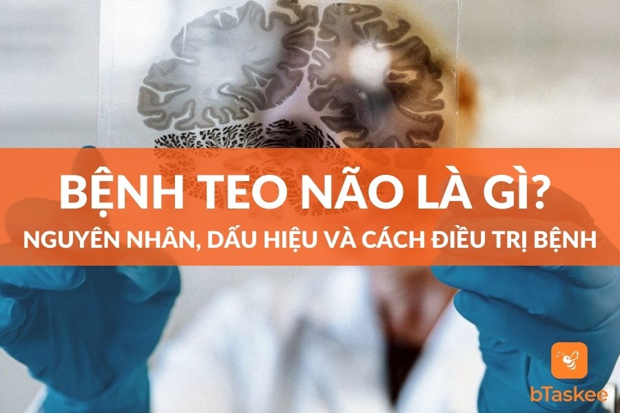 Bệnh Teo Não: Nguyên Nhân, Biểu Hiện, Cách Điều Trị
